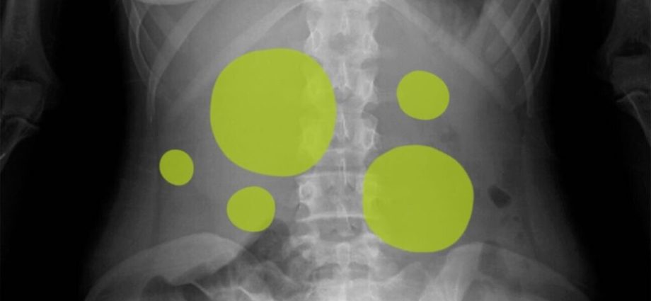 Gas formation in the intestines in adults