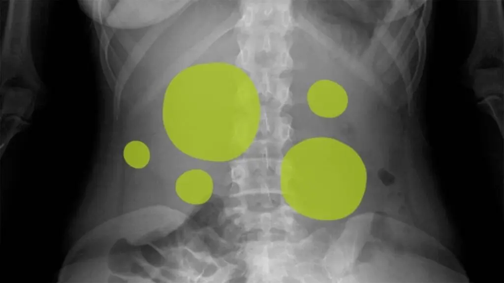 Gas formation in the intestines in adults