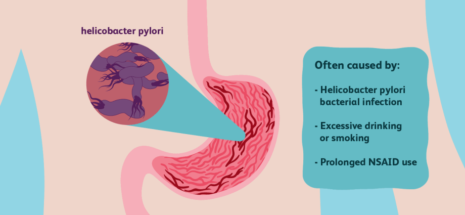 Gastritis of the stomach