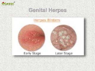 Genital herpes in men