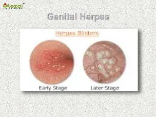 Genital herpes in men