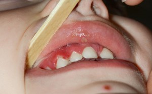 Gingivitis in children