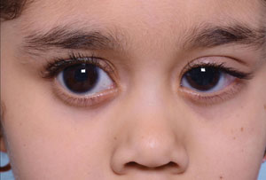 Glaucoma in children