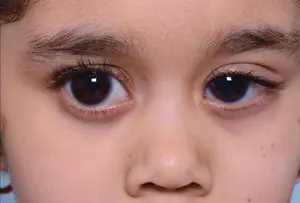 Glaucoma in children