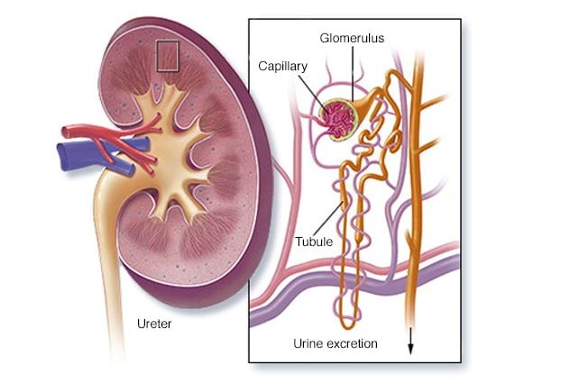 glomerulonephritis