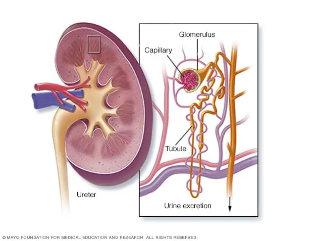 glomerulonephritis