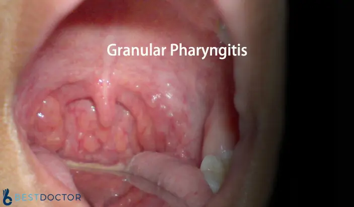 Granular pharyngitis in adults