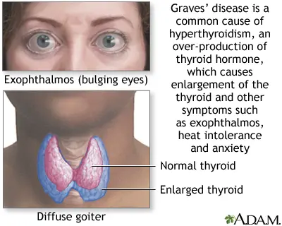 Graves&#8217; disease in adults