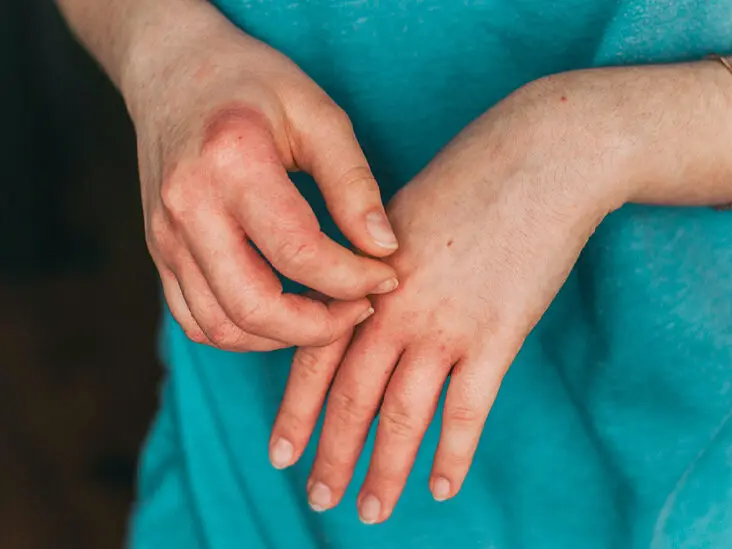 Hand allergies in adults