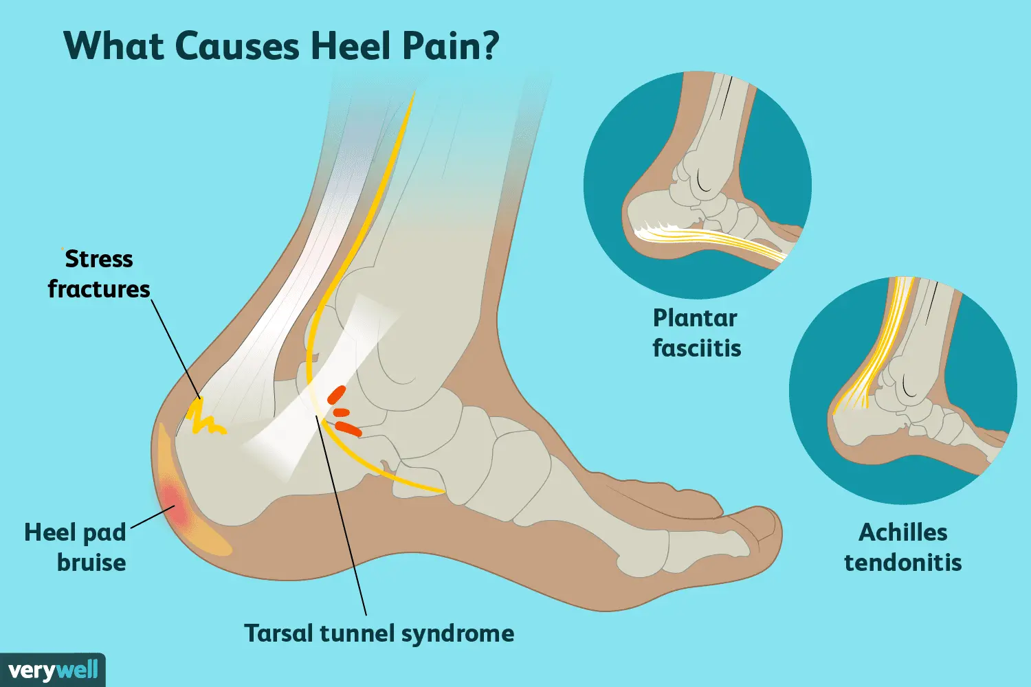 Heel pain