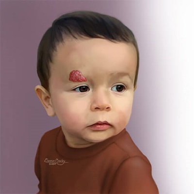 Hemangioma in a child