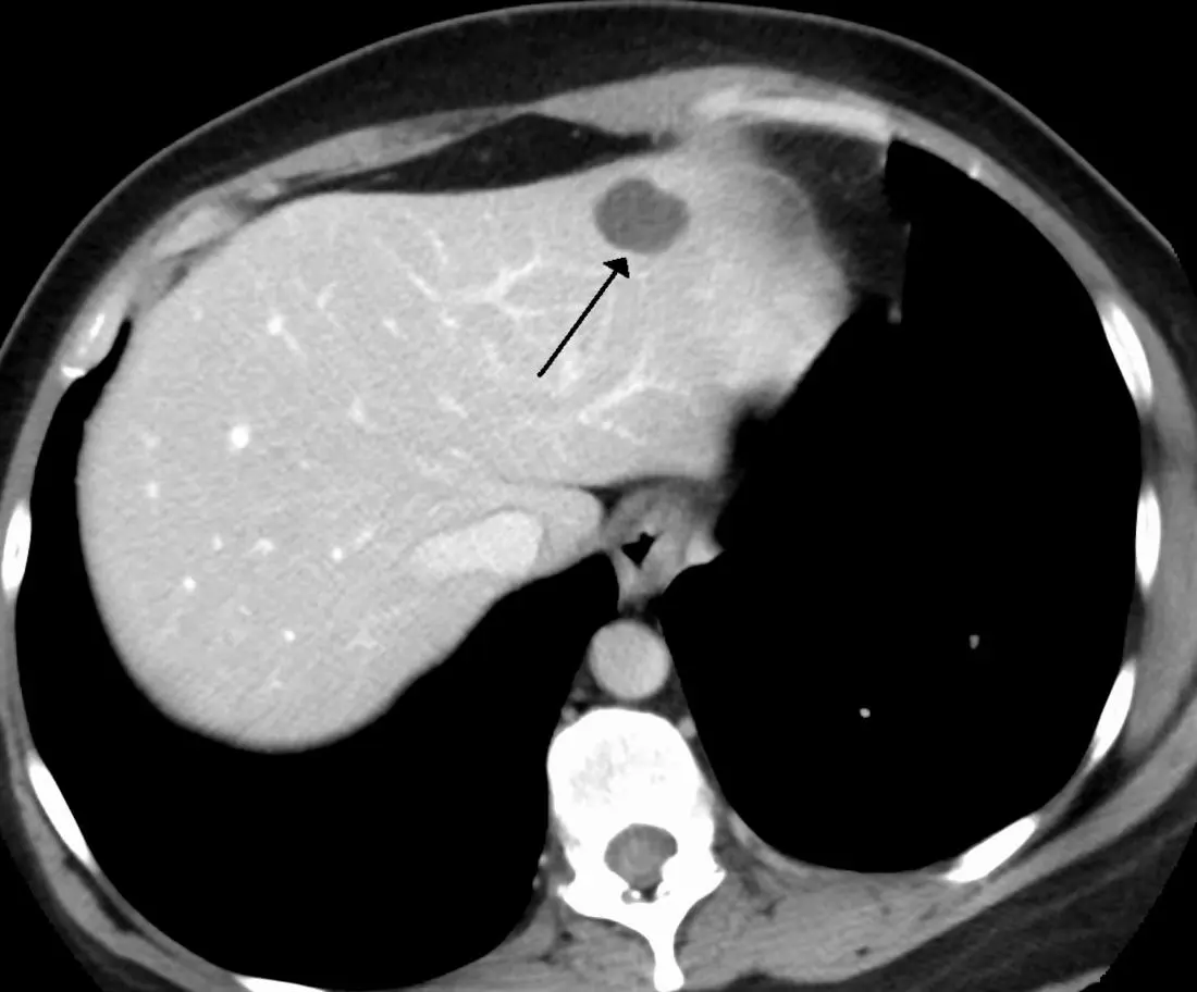 Hemangioma of the liver