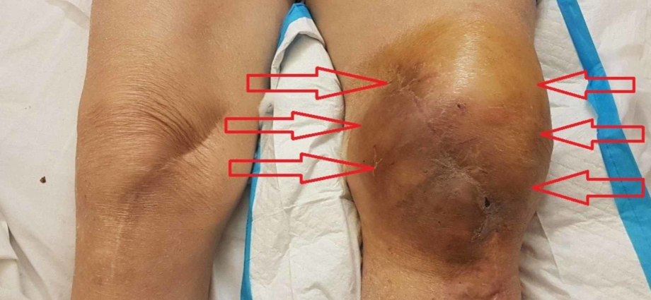 Hemarthrosis of the knee joint in adults