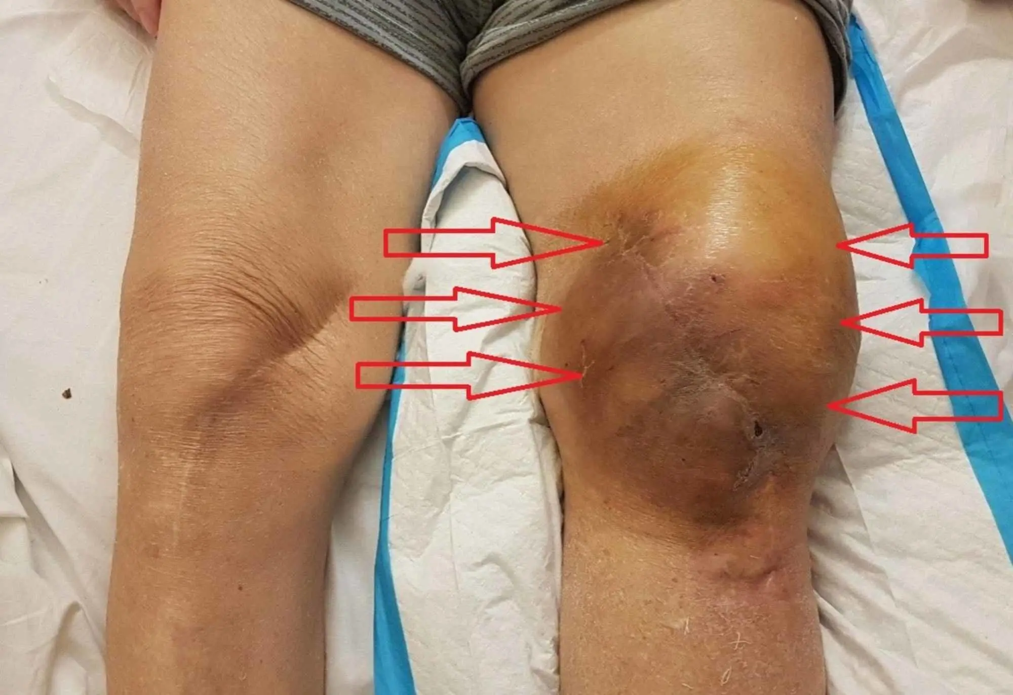 Hemarthrosis of the knee joint in adults