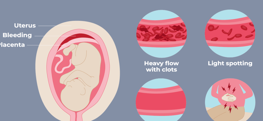 Hematoma during early pregnancy