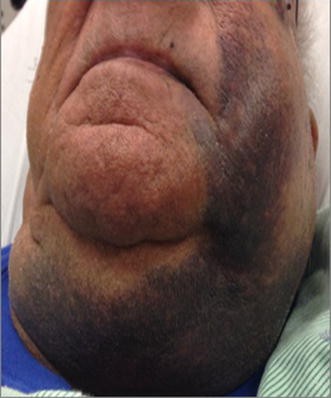 Hematoma on the face