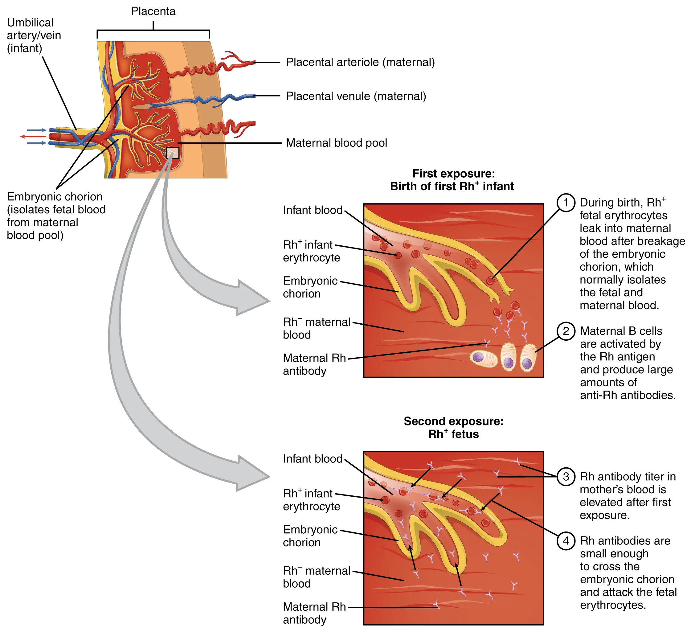 Hemolytic disease of the newborn