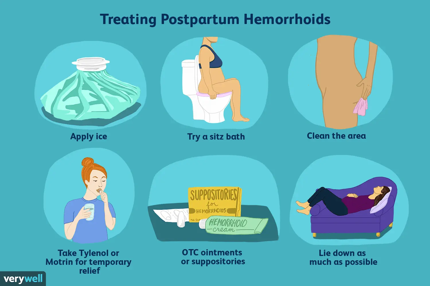 Hemorrhoids after childbirth