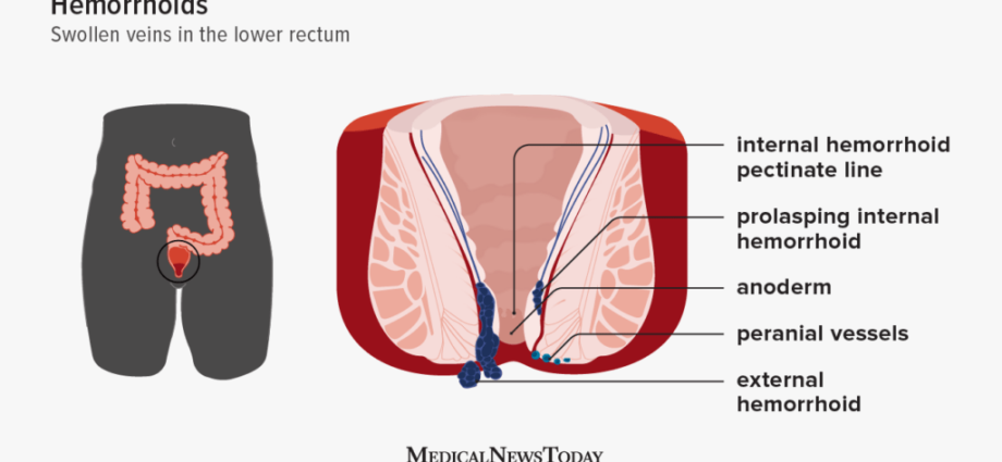 hemorrhoids in women