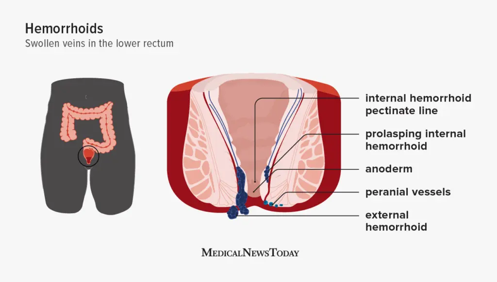 hemorrhoids in women