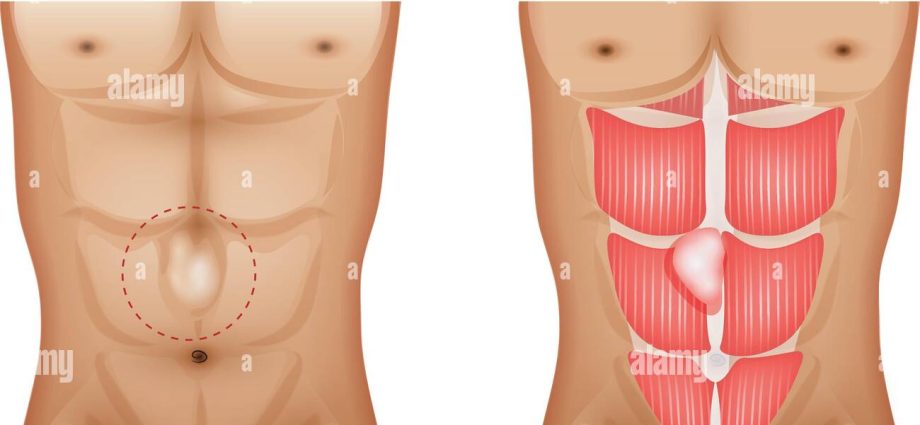 Hernia of the white line of the abdomen in adults