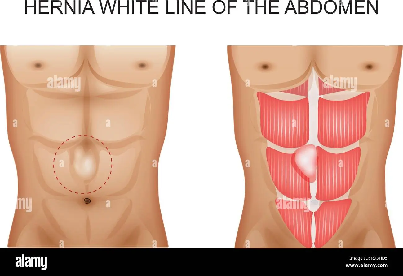 Hernia of the white line of the abdomen in adults