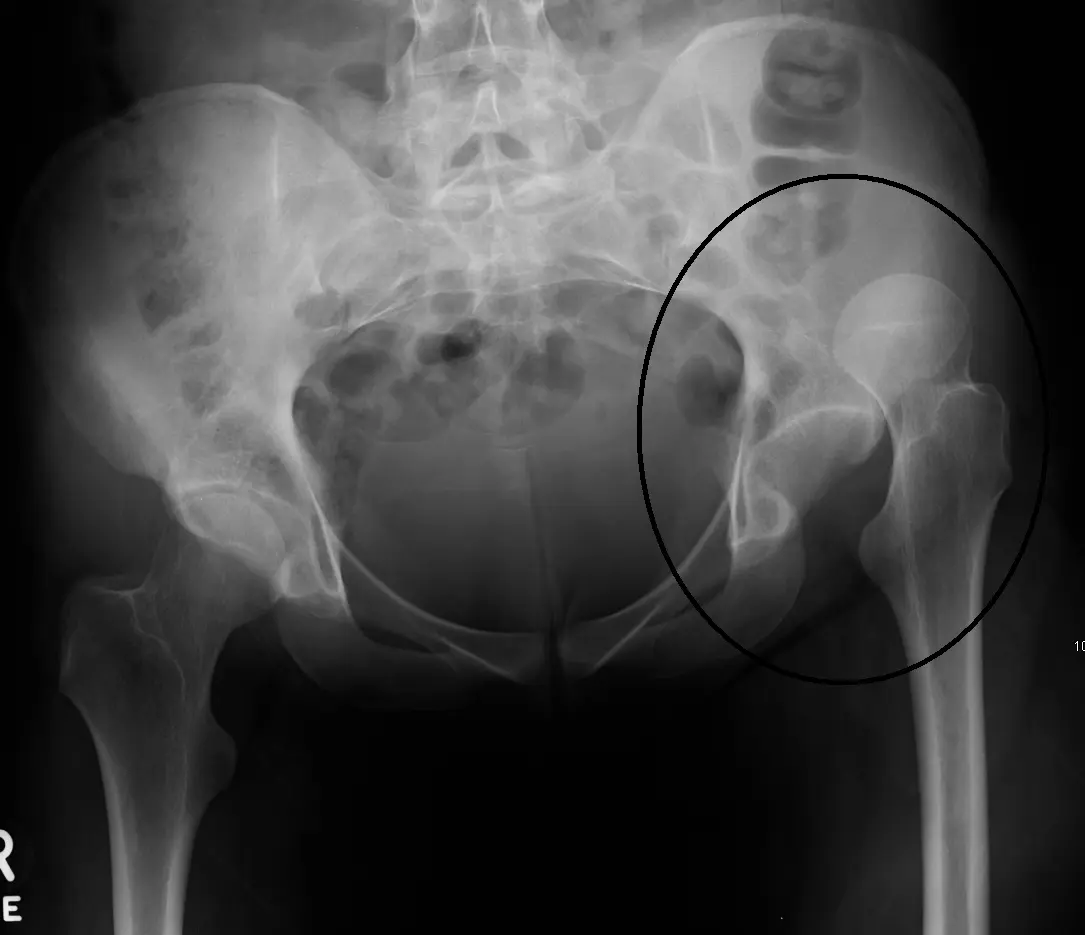 hip dislocation