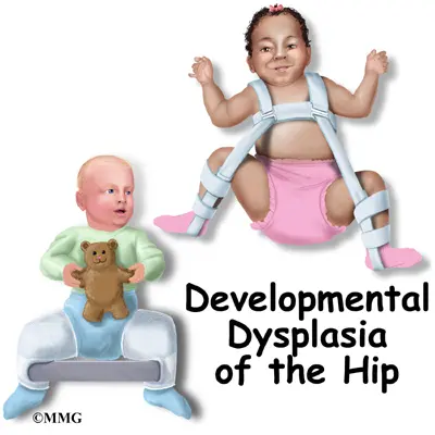 Hip dysplasia in children