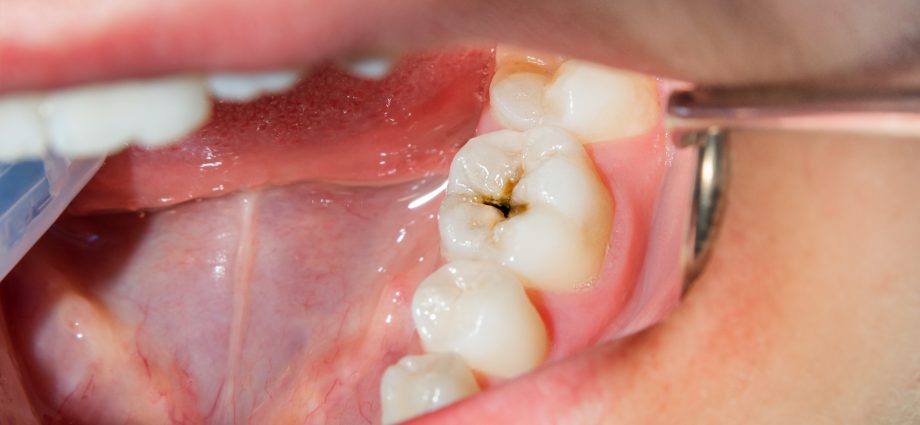 Hole in the tooth in adults