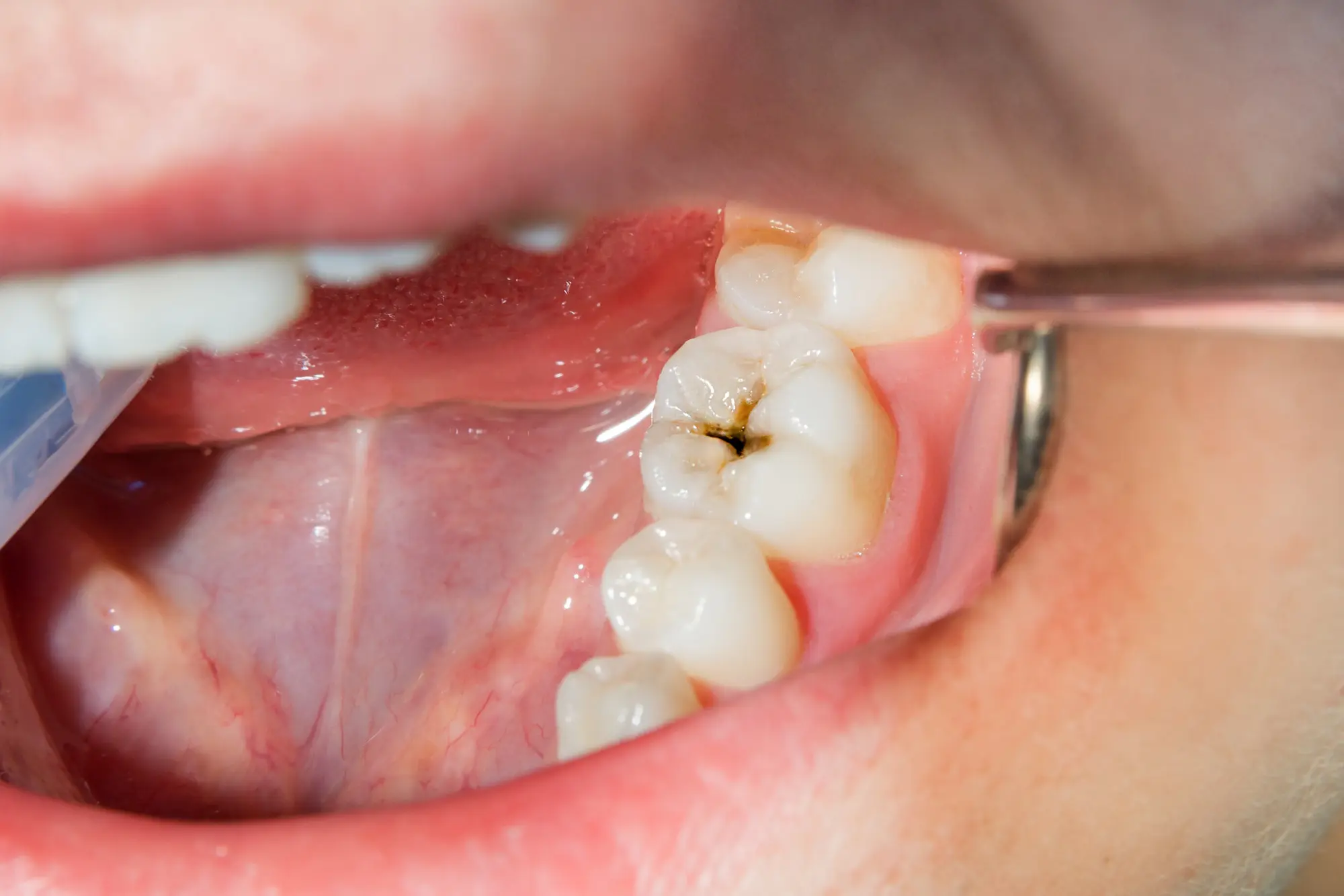 Hole in the tooth in adults