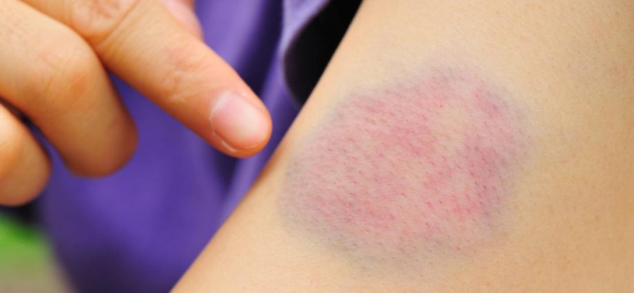 How to get rid of a bruise in adults at home