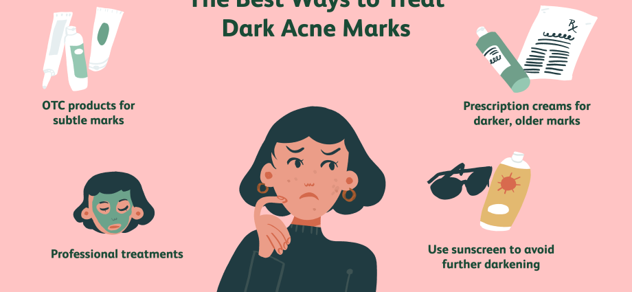 Hoe zich te ontdoen van post-acne op het gezicht