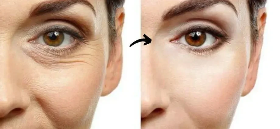 How to remove wrinkles under the eyes at home