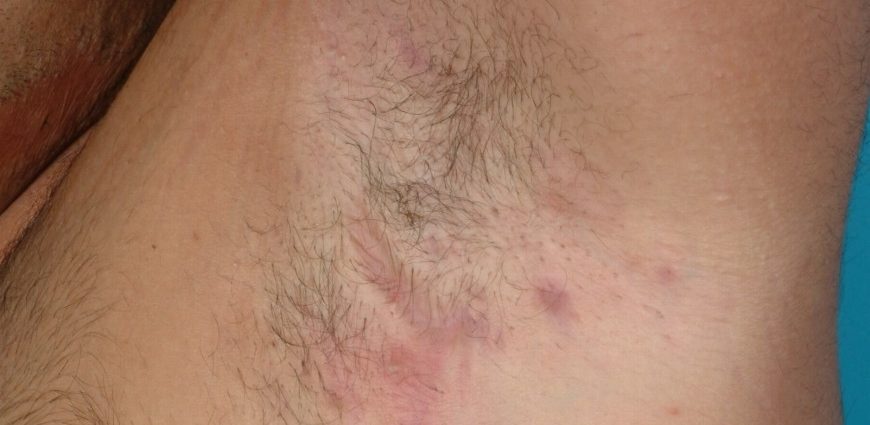 Hydradenitis in adults