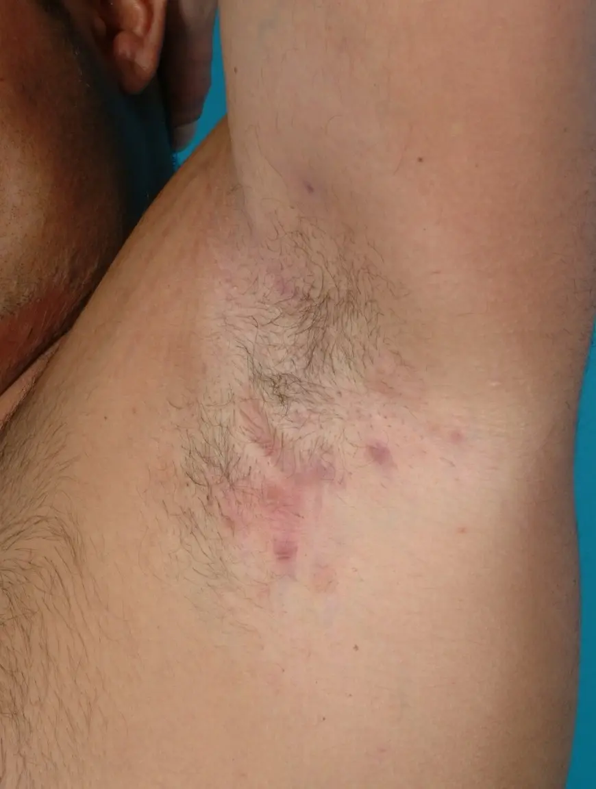 Hydradenitis in adults