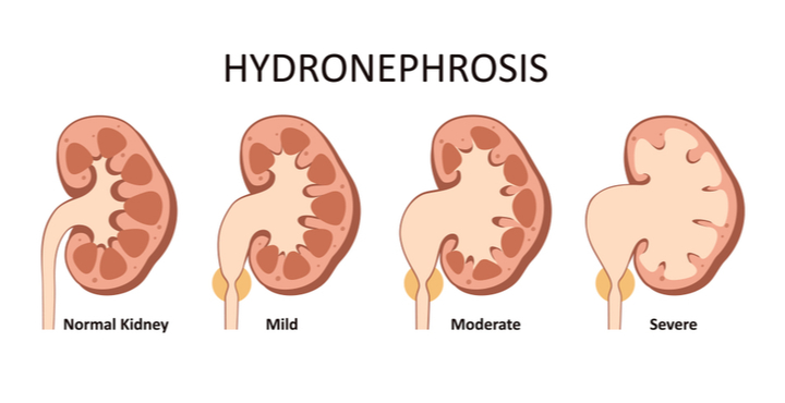 Hydronephrosis of the kidneys in adults