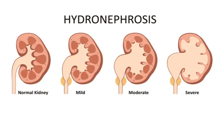 Hydronephrosis of the kidneys in adults