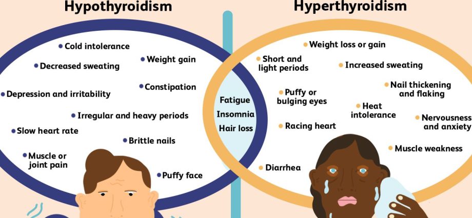 Hypothyroidism in adults