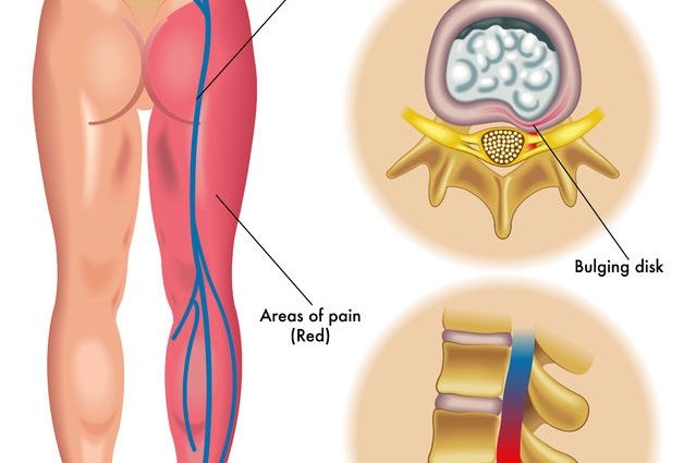 Inflammation of the sciatic nerve