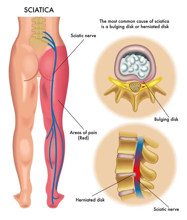 Inflammation of the sciatic nerve