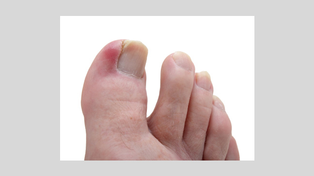 Ingrown toenail in adults