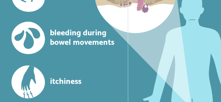 Internal hemorrhoids in women