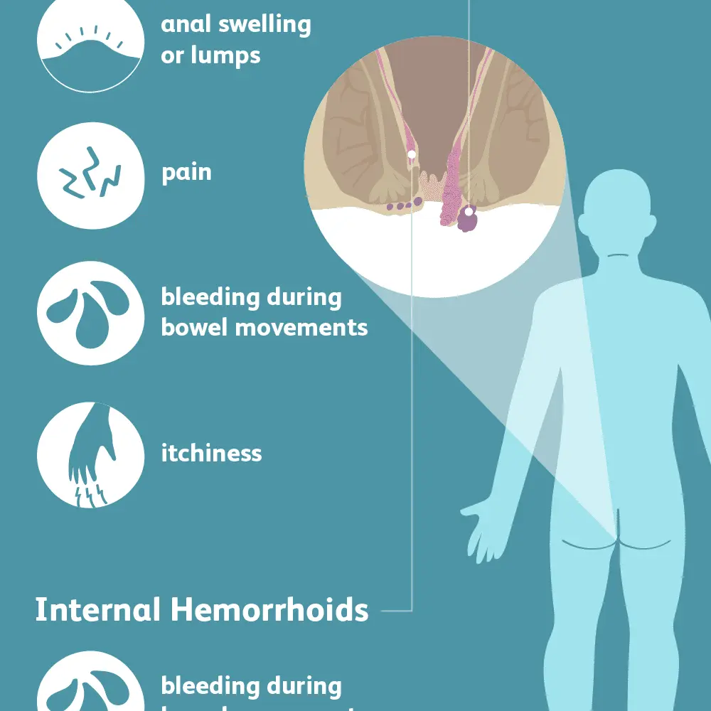 Internal hemorrhoids in women