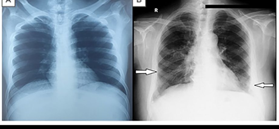 Interstitial pneumonia in adults