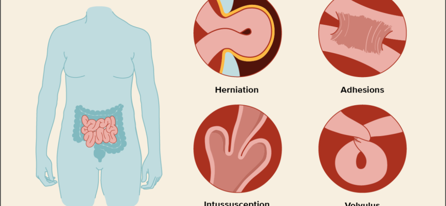 Intestinal obstruction in adults