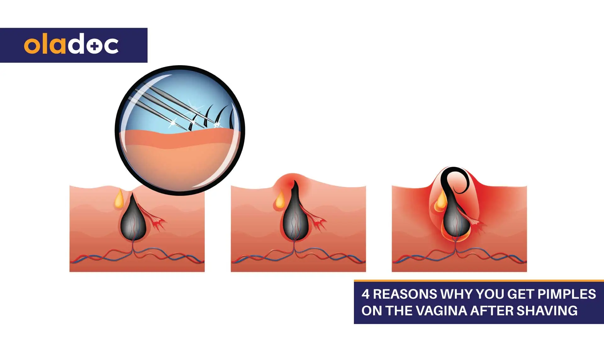 Irritation after shaving in the intimate area in women