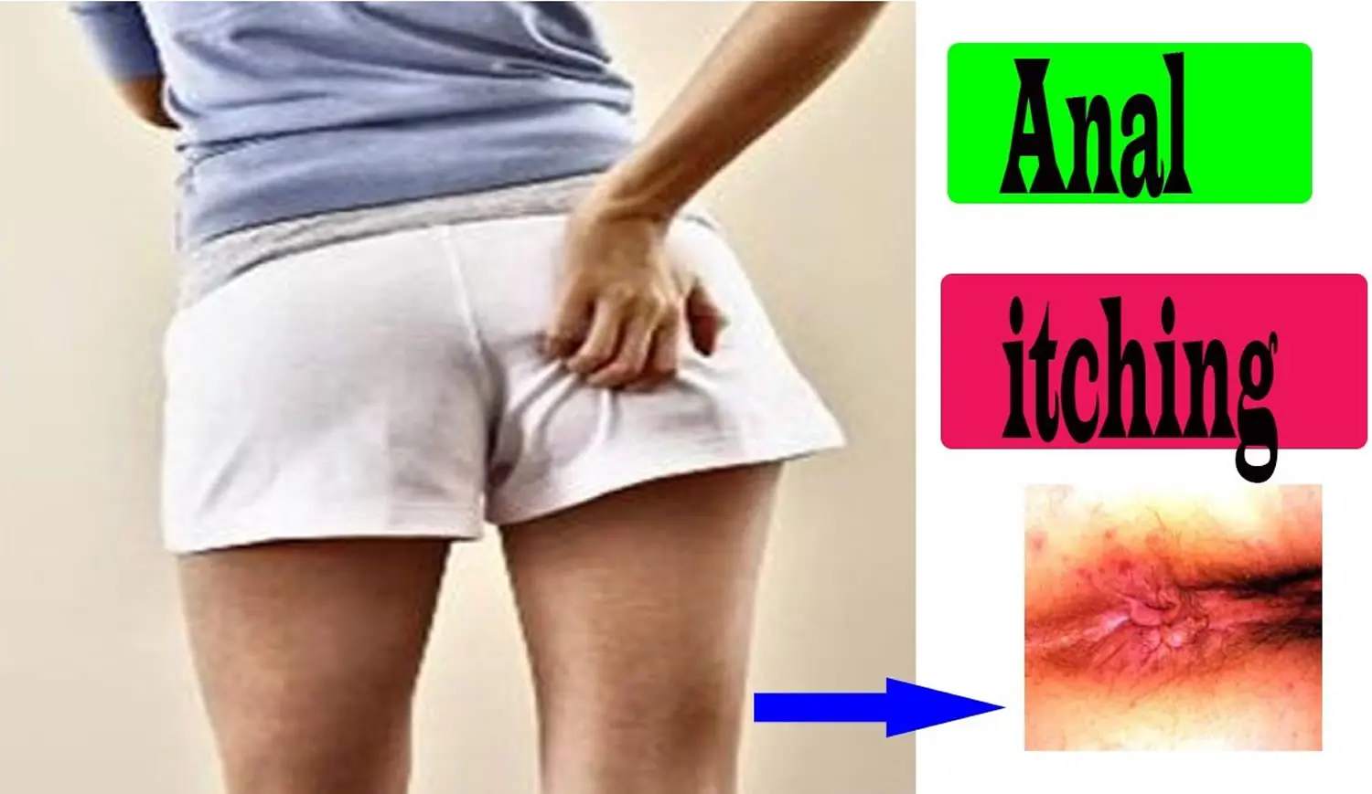 Itching in the anus in women and men