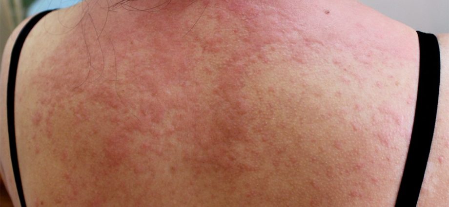 Itchy skin in adults