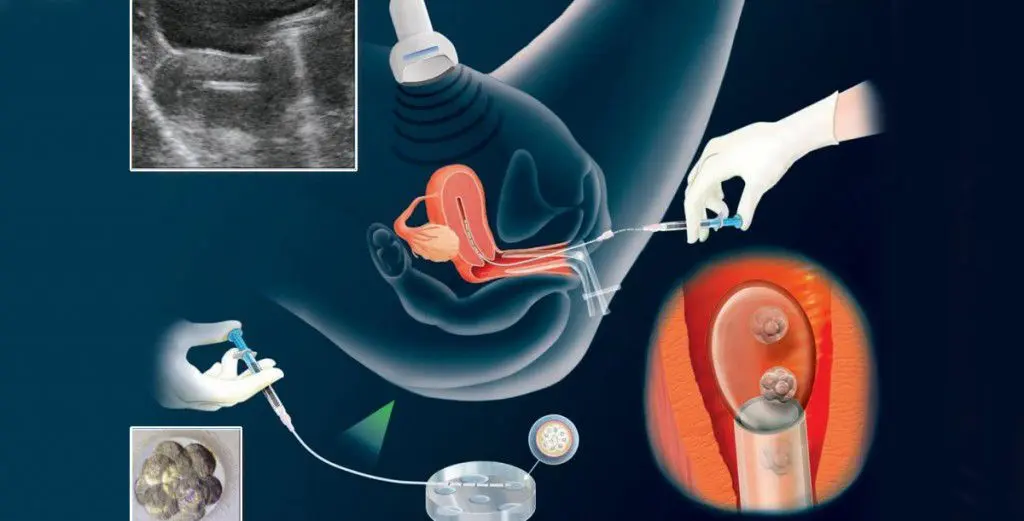 IVF Embryo Transfer