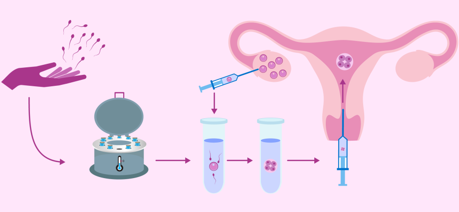 IVF with donor sperm